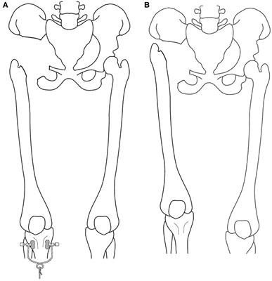 Less is better than more with resection of periacetabular tumors – A retrospective 16 years study and literature review